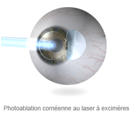 Photoablation cornéenne au laser à excimères